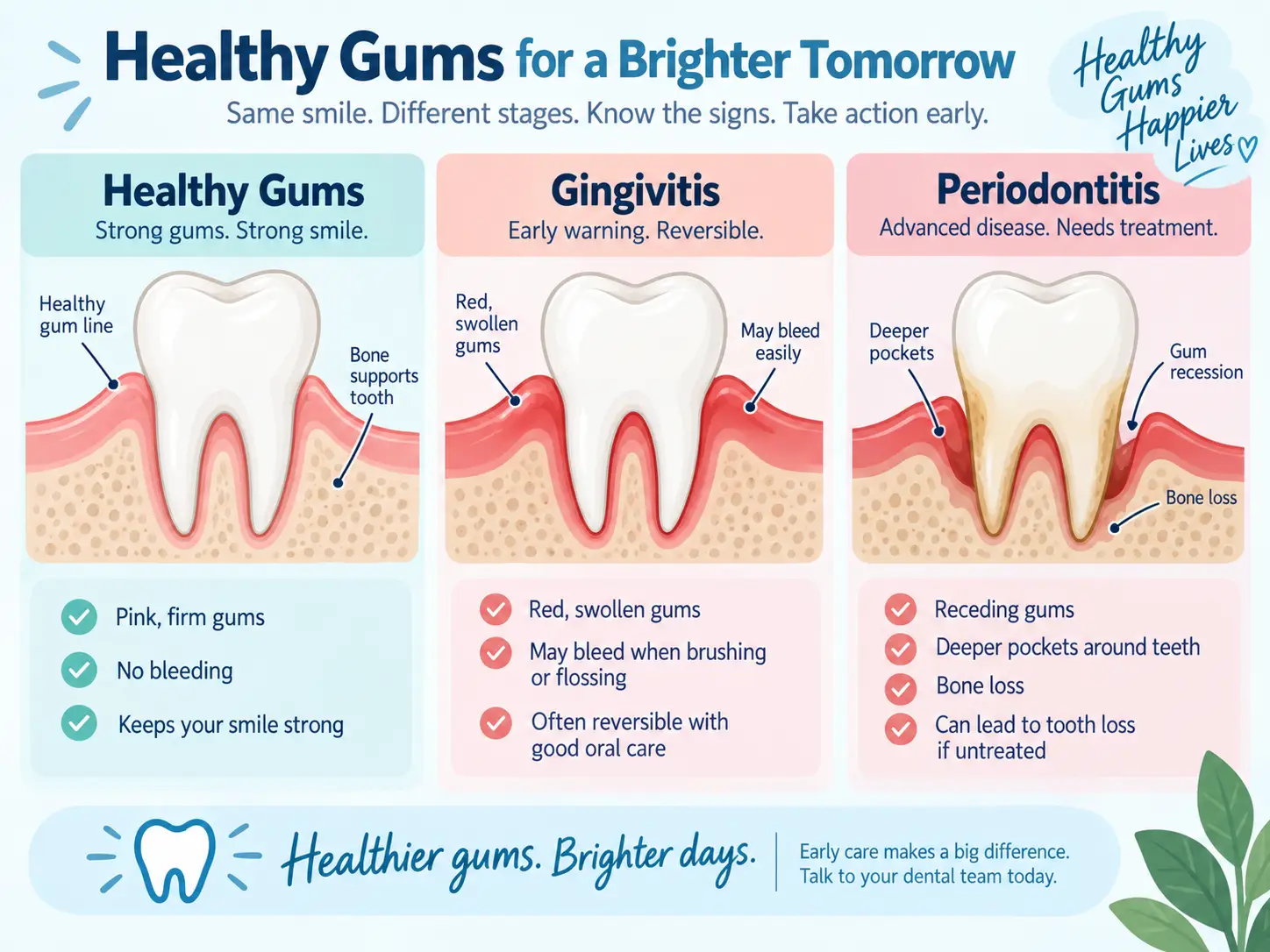 Illustration comparing healthy gums, gingivitis and periodontitis, showing bleeding and swollen gums, deeper gum pockets, gum recession and bone loss.