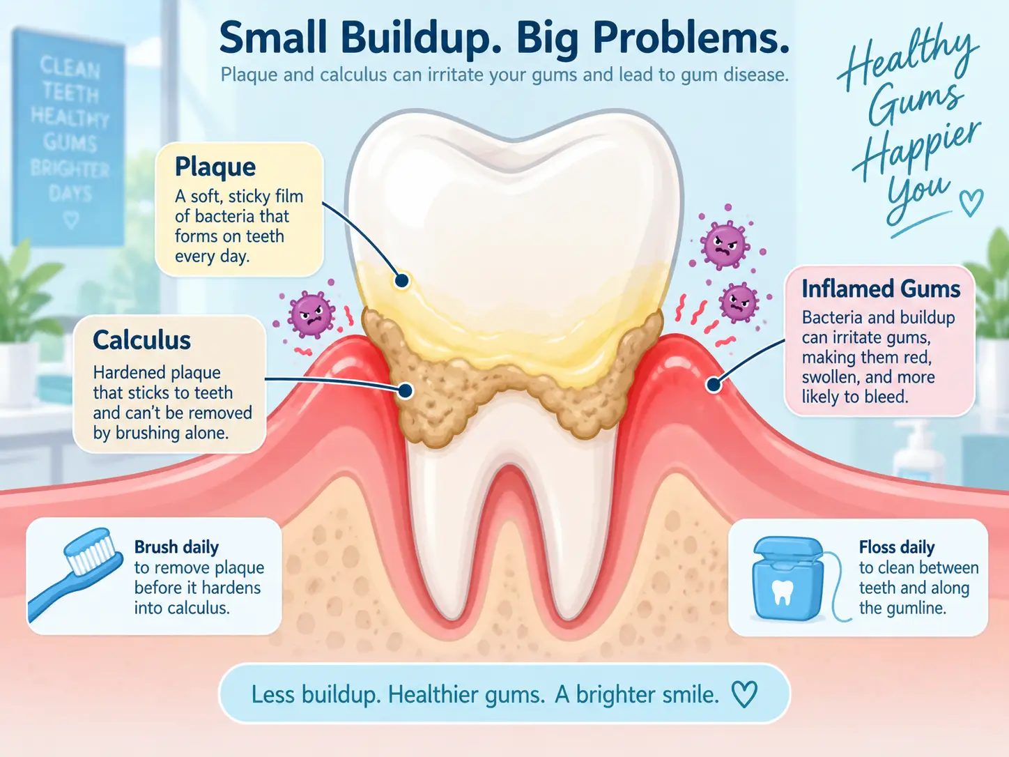 Illustration showing plaque and hardened calculus around a tooth causing red, inflamed gums that may bleed.